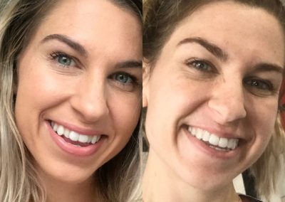 candid-pro-invisible-liners-radiant-smiles-tucson-before-after-photo-9