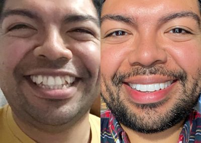 candid-pro-invisible-liners-radiant-smiles-tucson-before-after-photo-8