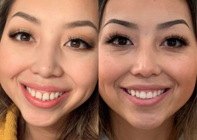 candid-pro-invisible-liners-radiant-smiles-tucson-before-after-photo-7