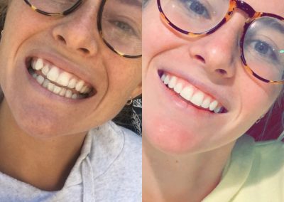 candid-pro-invisible-liners-radiant-smiles-tucson-before-after-photo-6