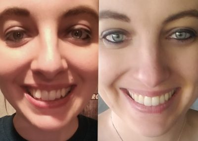 candid-pro-invisible-liners-radiant-smiles-tucson-before-after-photo-5