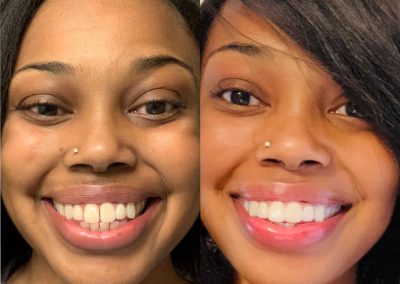 candid-pro-invisible-liners-radiant-smiles-tucson-before-after-photo-4