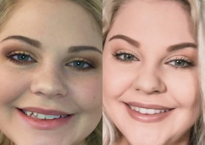 candid-pro-invisible-liners-radiant-smiles-tucson-before-after-photo-3