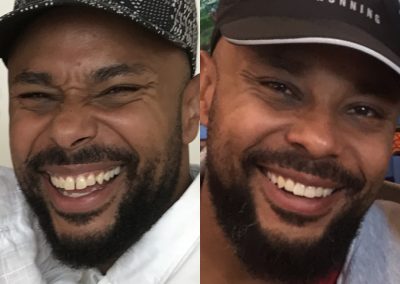 candid-pro-invisible-liners-radiant-smiles-tucson-before-after-photo-2