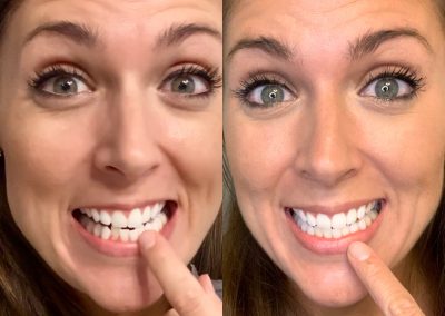 candid-pro-invisible-liners-radiant-smiles-tucson-before-after-photo-1