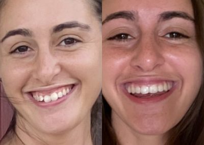 candid-pro-invisible-liners-radiant-smiles-tucson-before-after-photo-13