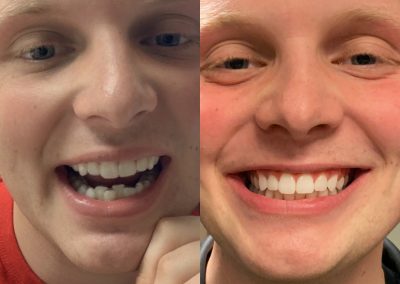 candid-pro-invisible-liners-radiant-smiles-tucson-before-after-photo-12