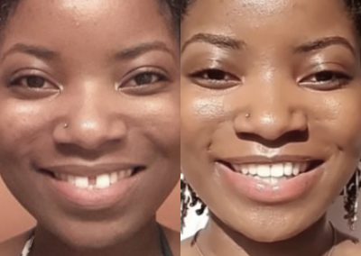 candid-pro-invisible-liners-radiant-smiles-tucson-before-after-photo-11