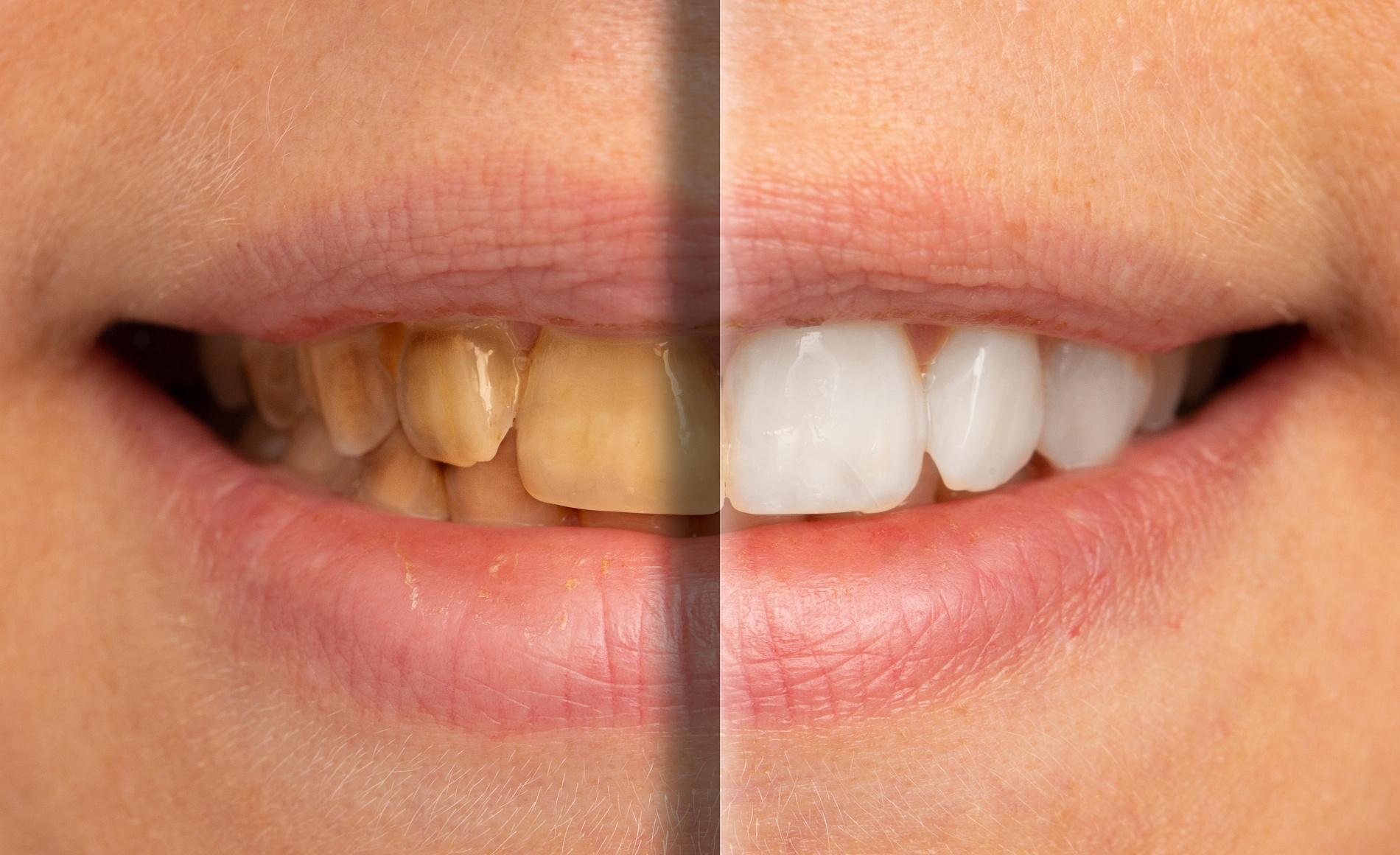 composite-bonding-before-after