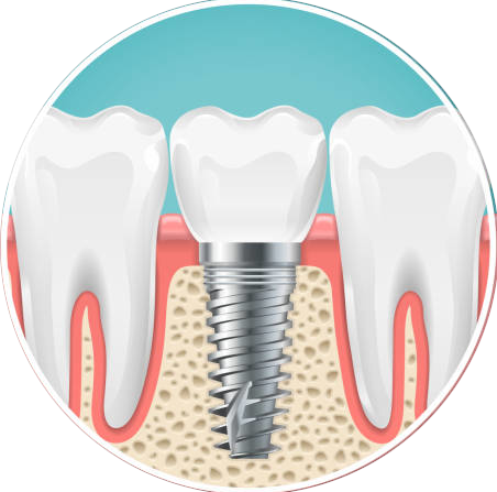 tucson-dental-impant-services