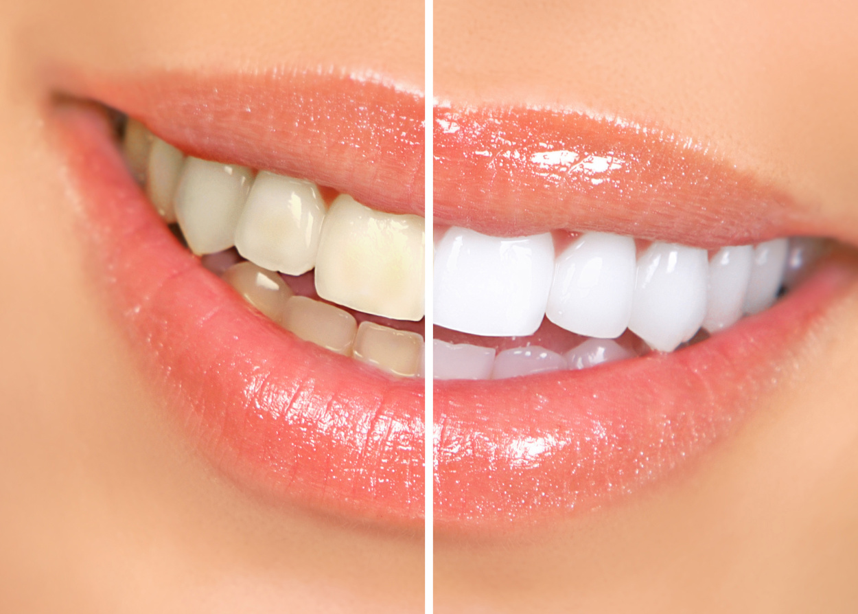 teeth-whitening-radiants-smiles-tucson