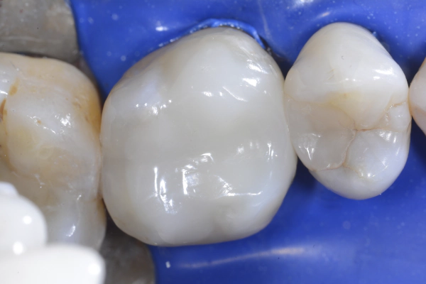 After photo with Bioclear