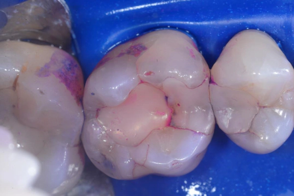 Before photo of Bioclear