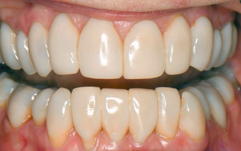 after bioclear picture