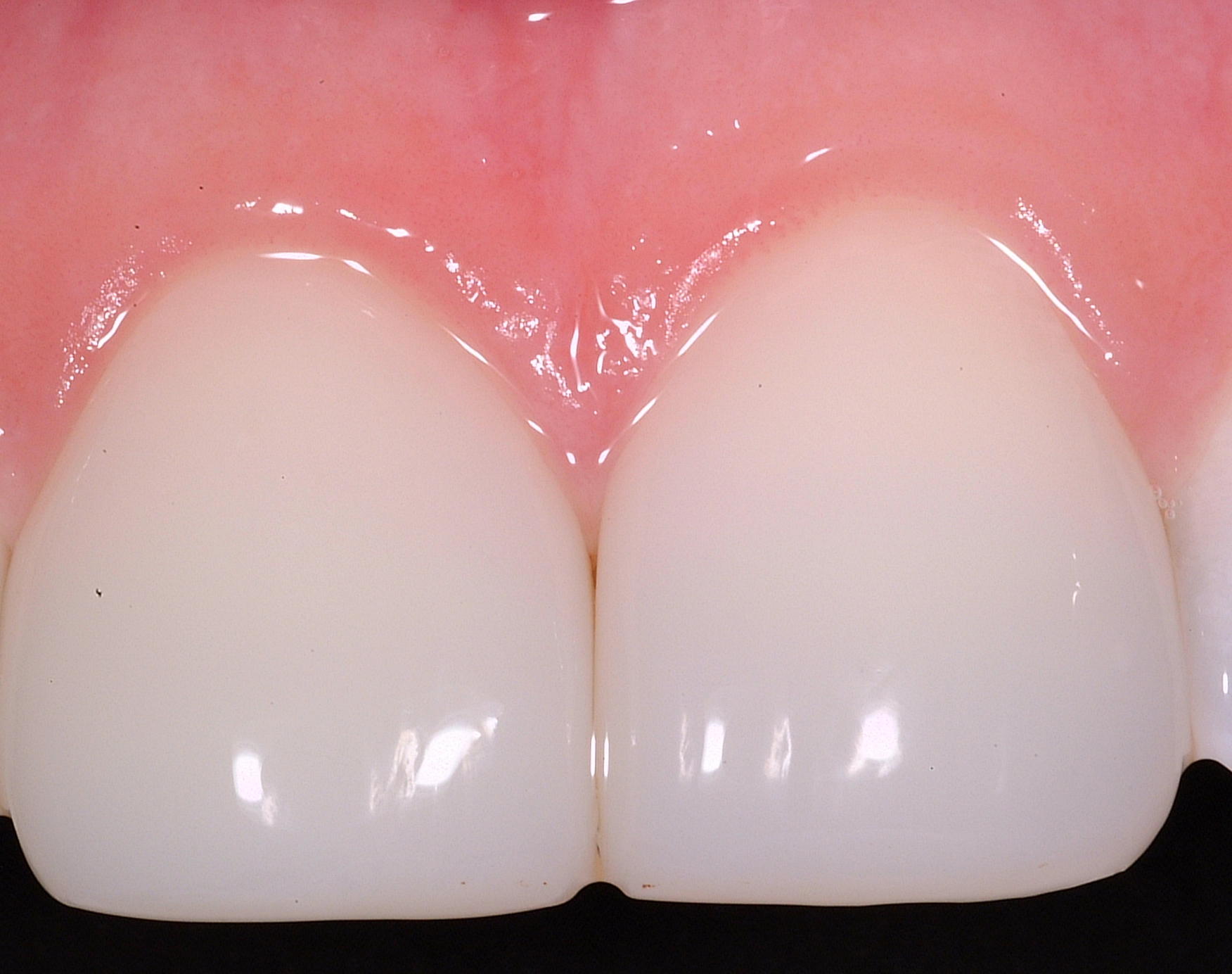 Photo of after front tooth repair using Bioclear