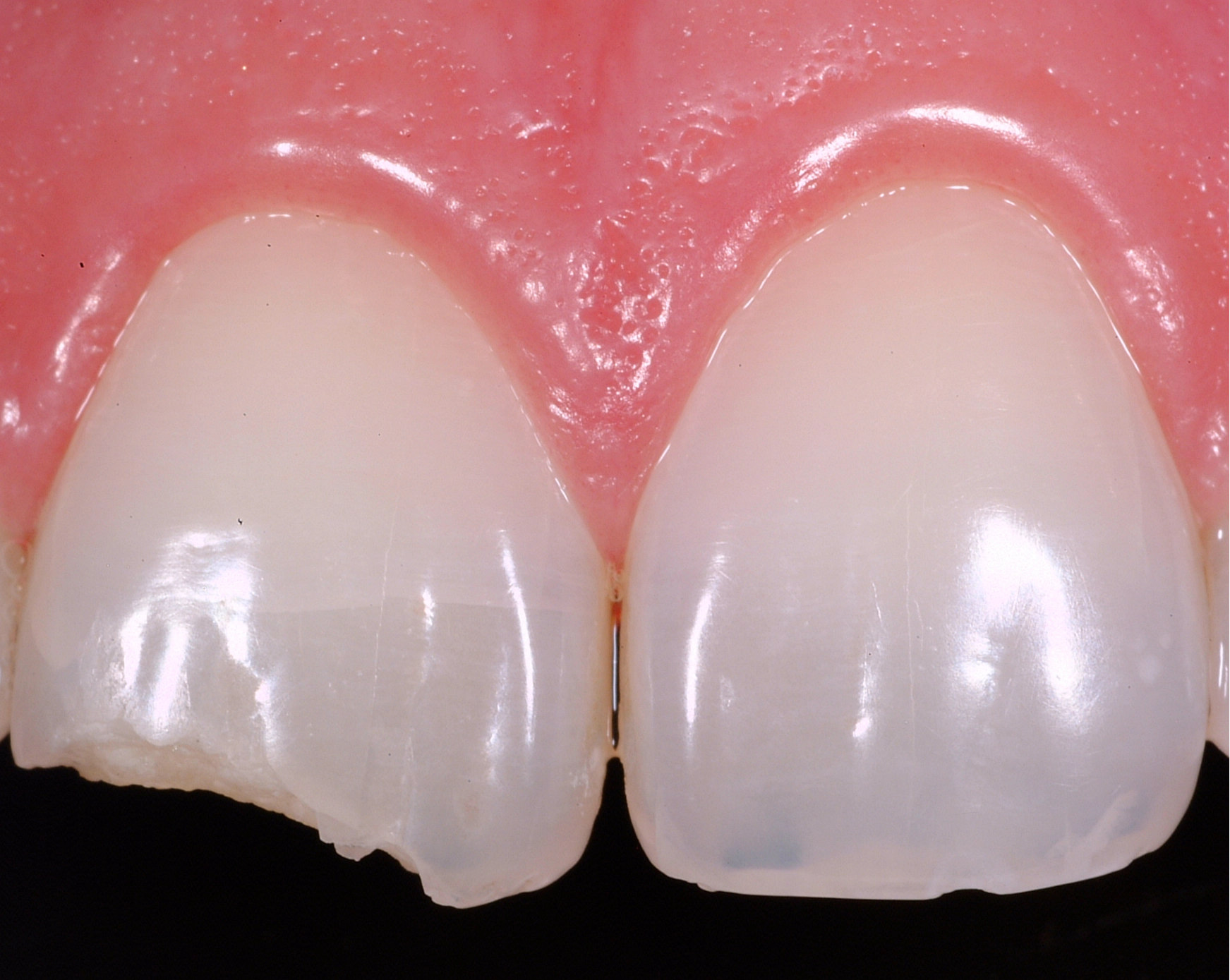 Photo of Front tooth repair using Bioclear